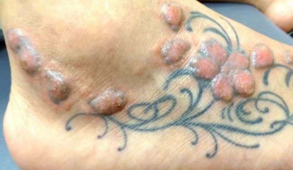 O que é envenenamento por tinta de tatuagem